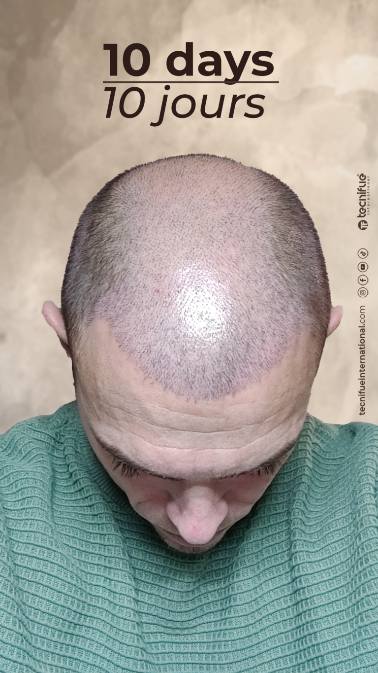 Évolution de la greffe capillaire FUE : 10ème jour