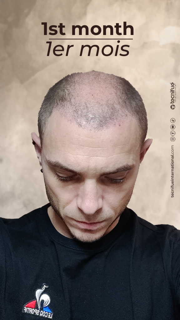 Évolution de la greffe capillaire FUE : 1er mois Le Shock Loss