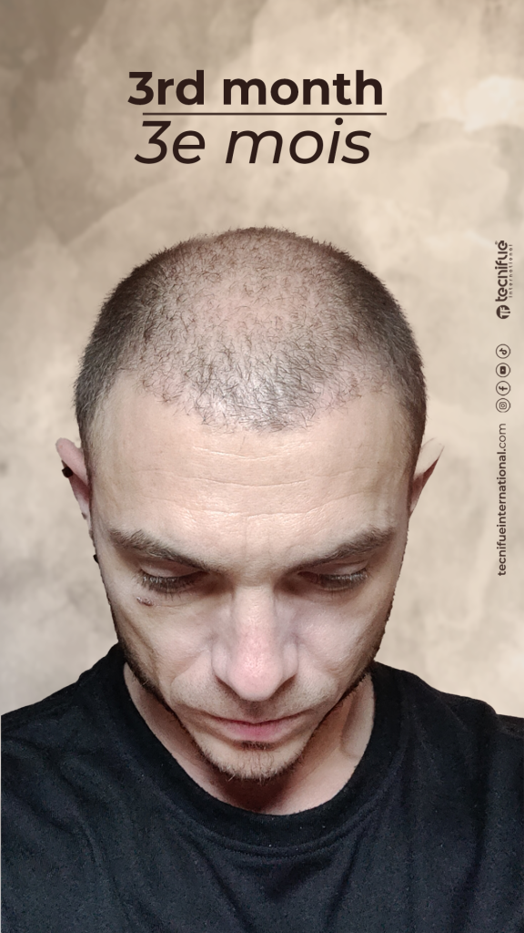 Évolution de la greffe capillaire FUE : 3ème mois