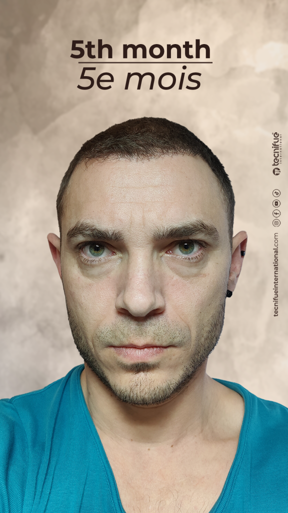 Évolution de la greffe capillaire FUE : 4ème mois Le Shock Loss