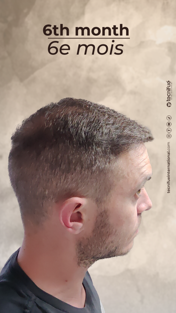 Évolution de la greffe capillaire FUE : 6eme mois