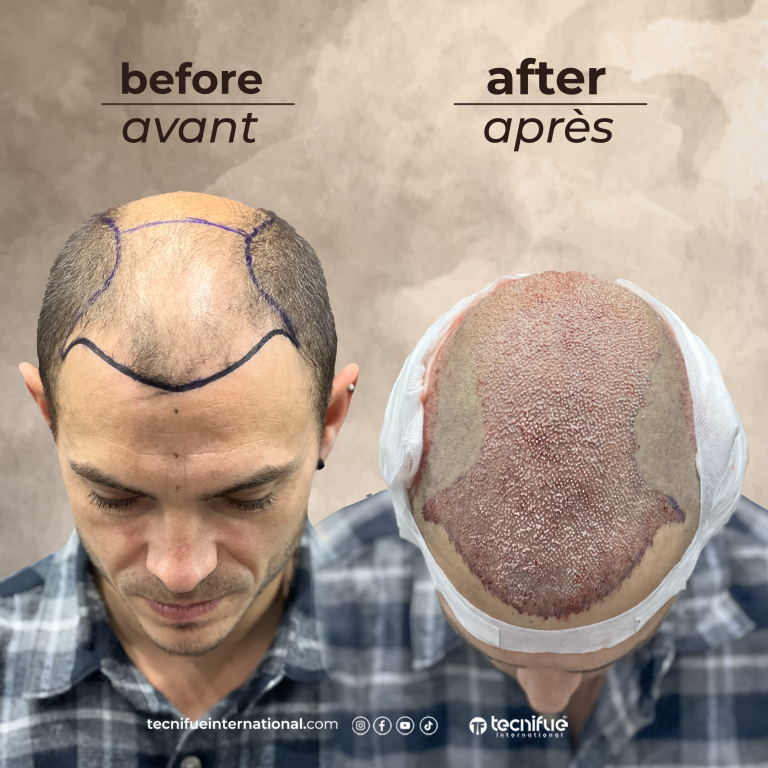 Évolution de la greffe capillaire FUE : 1er jour
