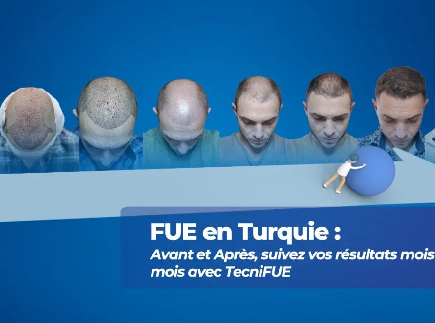Évolution de la greffe FUE en Turquie : Avant et Après, mois par mois