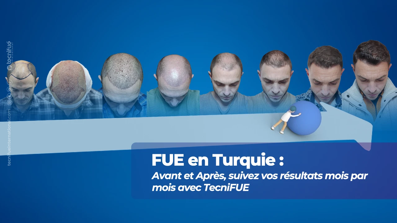 Évolution de la greffe FUE en Turquie : Avant et Après, mois par mois
