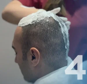 Soins Greffe de Cheveux
