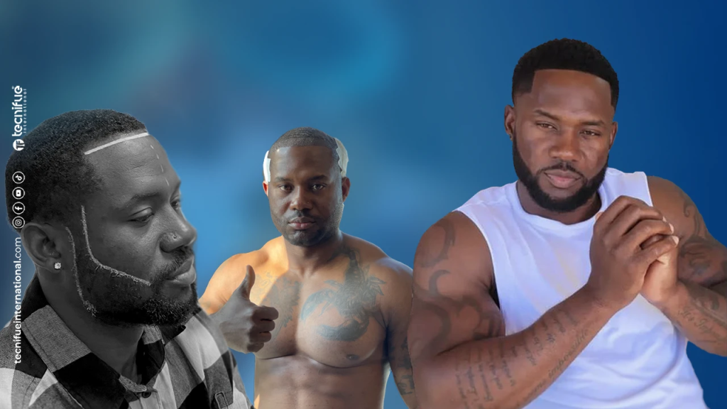 Résultat Greffe de Barbe Afro 2024