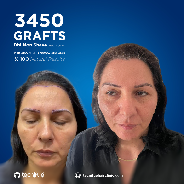 Greffe de Sourcils Femme Turquie