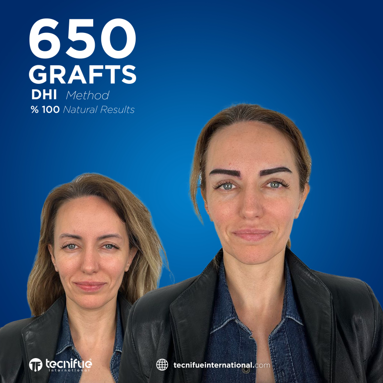 Greffe de Sourcils en Turquie Résultat Avant Après