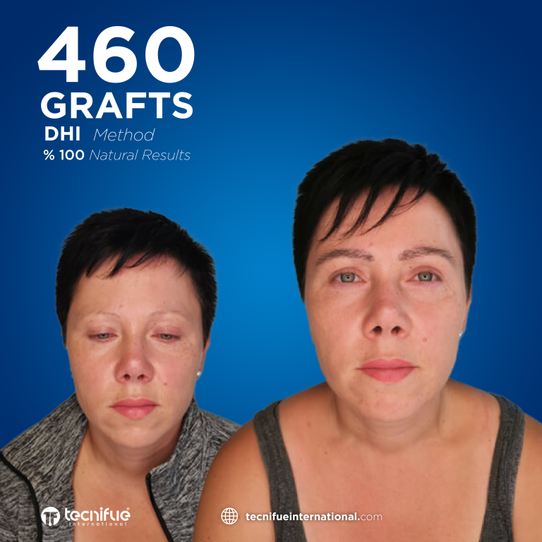 Greffe de Sourcils en Turquie Résultat Avant Après