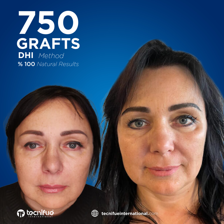 Greffe de Sourcils en Turquie Résultat Avant Après