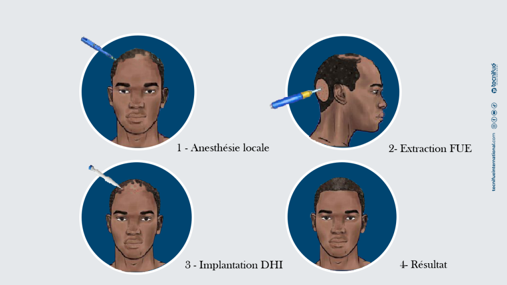 Greffe de cheveux DHI Afro