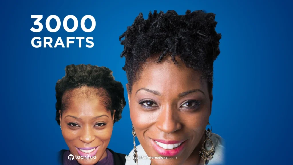 Greffe de Cheveux Afro femme