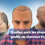 Etape d'une greffe de cheveux FUE