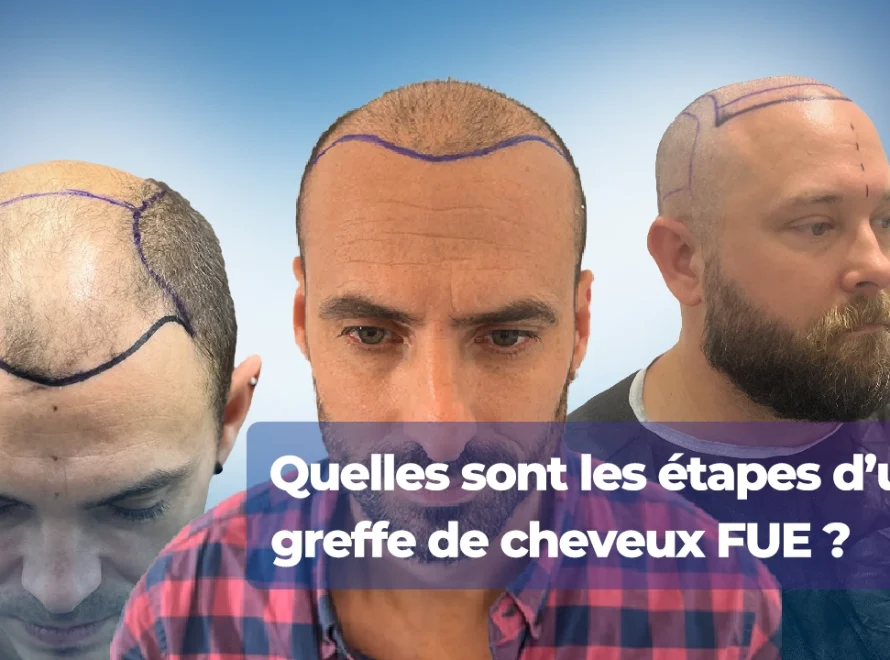 Etape d'une greffe de cheveux FUE