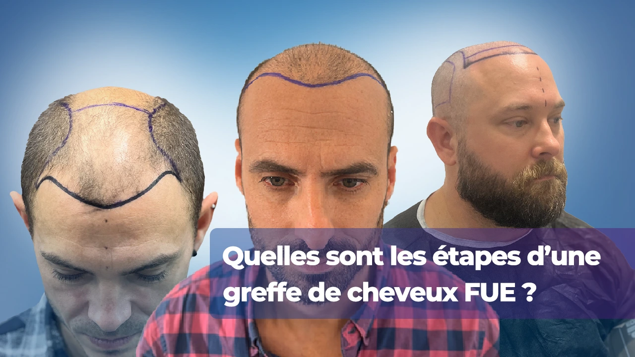 Etape d'une greffe de cheveux FUE