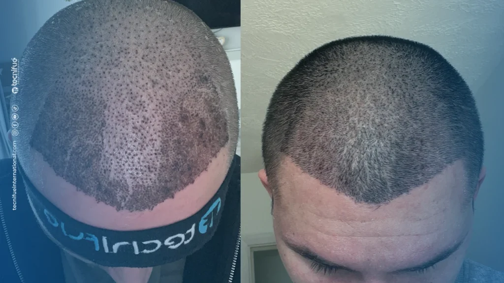 10 eme jour après la Greffe de cheveux