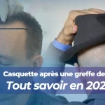 Casquette après une greffe de cheveux - Tout savoir en 2025