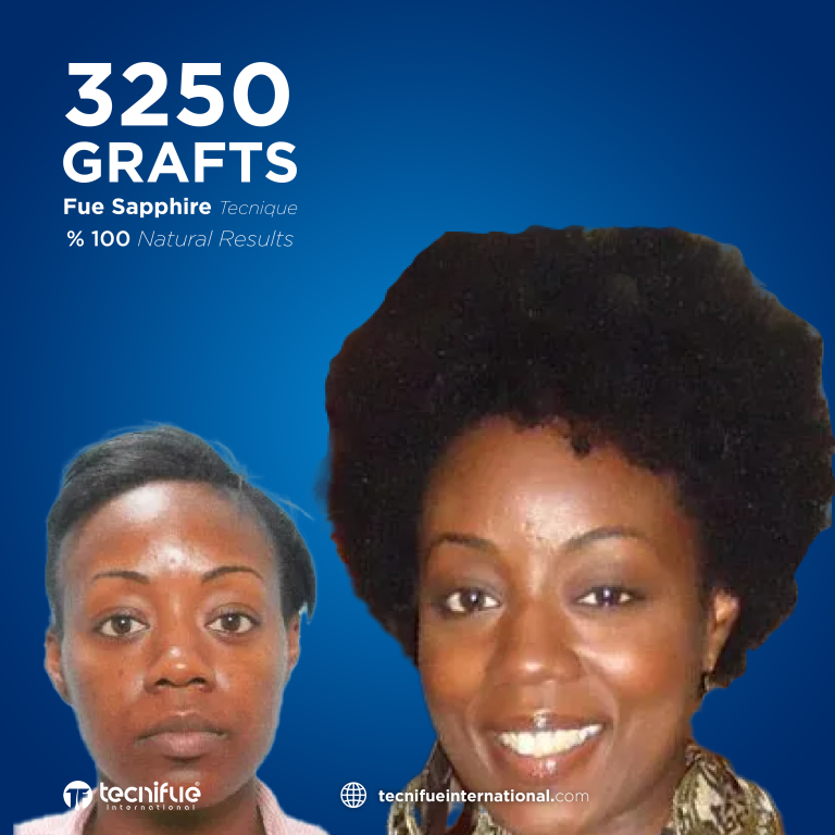 Greffe de cheveux pour Femme : Afro