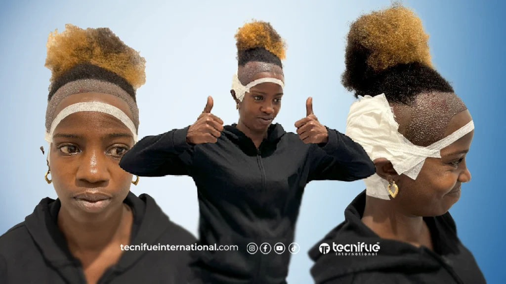 Greffe de Cheveux Afro Femme