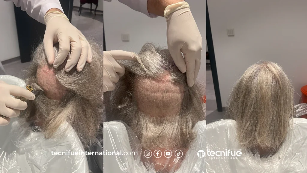 Greffe de cheveux sans rasage complet