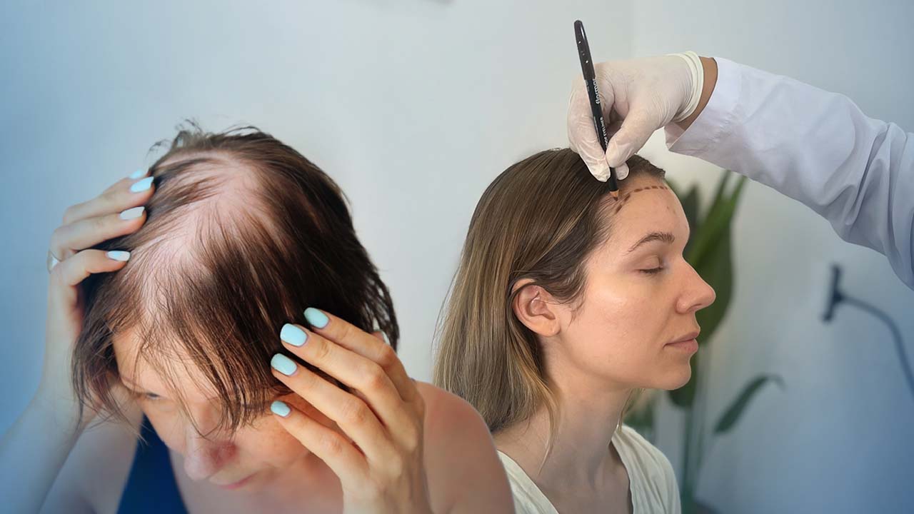 Greffe de cheveux pour Femme