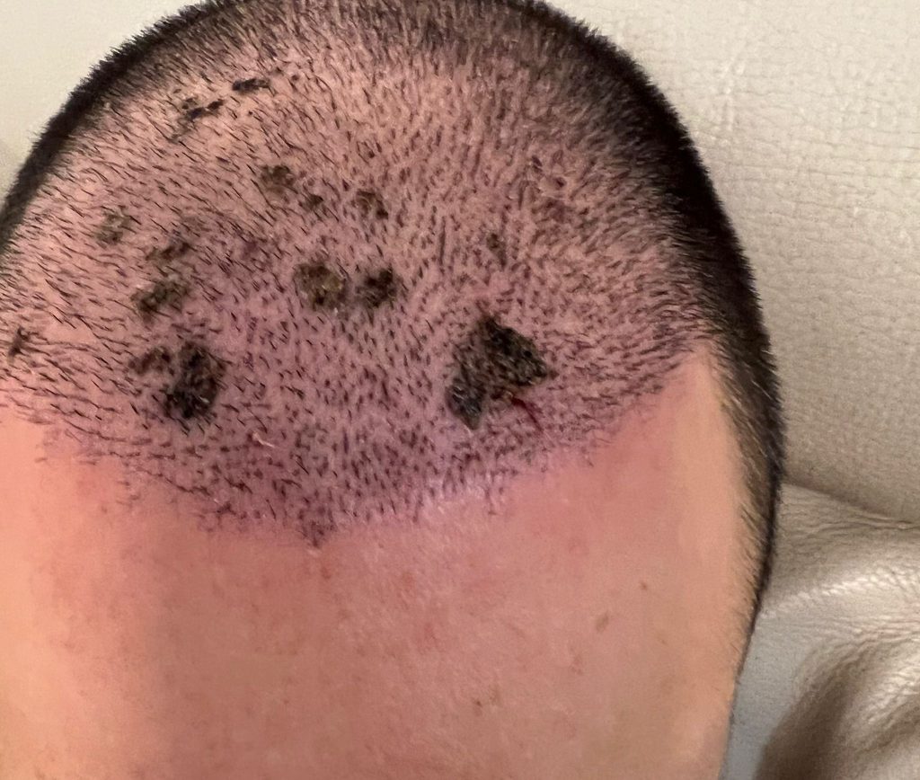 Hair Transplant Infection Pictures