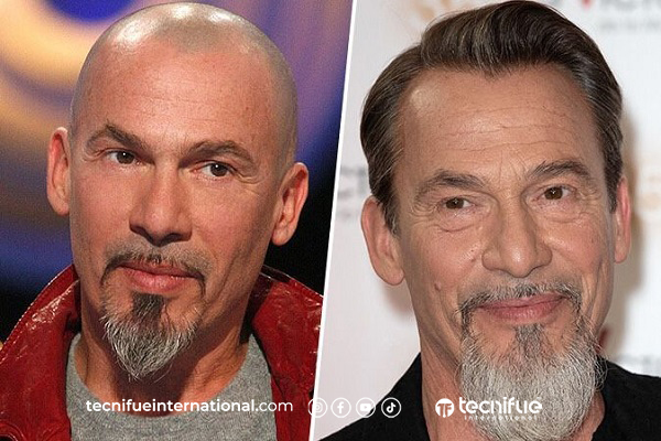 Résultat de greffe de cheveux Florent Pagny