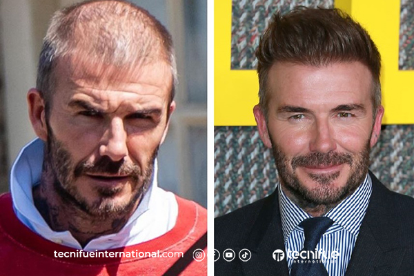 Greffe de cheveux David Beckham
