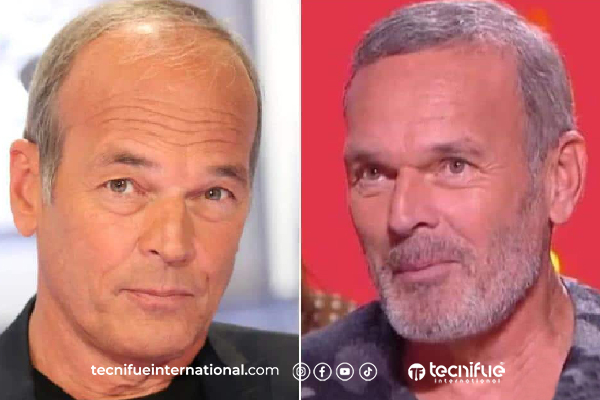 Résultat de greffe de cheveux Laurent Baffie