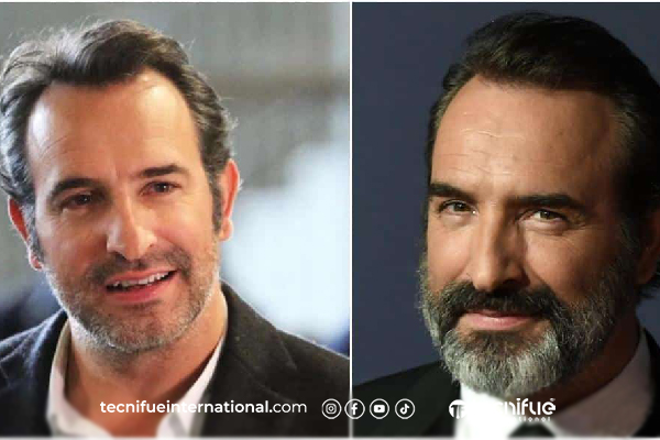 Résultat de greffe de cheveux Jean Dujardin