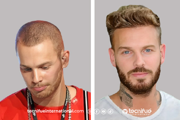 Résultat de greffe de cheveux Matt Pokora