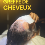 Soleil après une greffe de cheveux