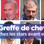 Greffe de cheveux chez les stars cover