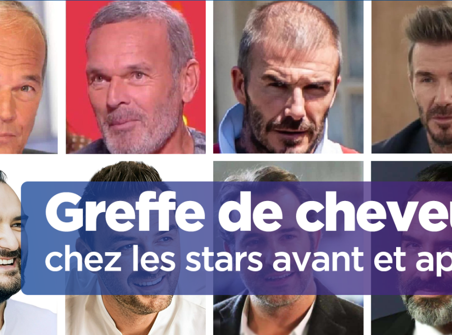 Greffe de cheveux chez les stars cover