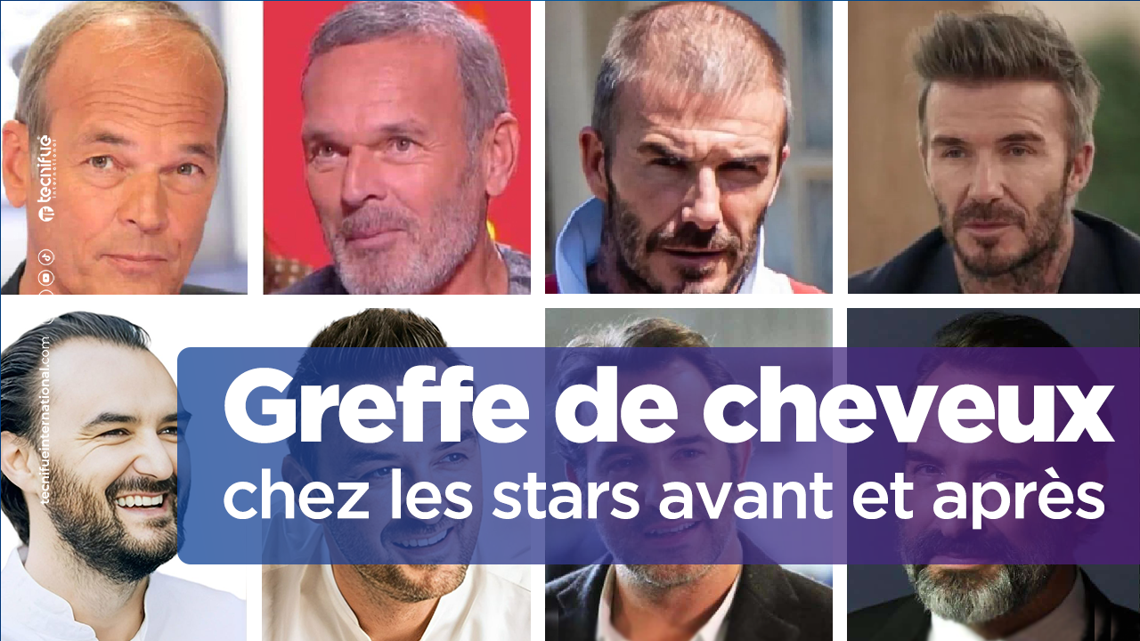 Greffe de cheveux chez les stars cover