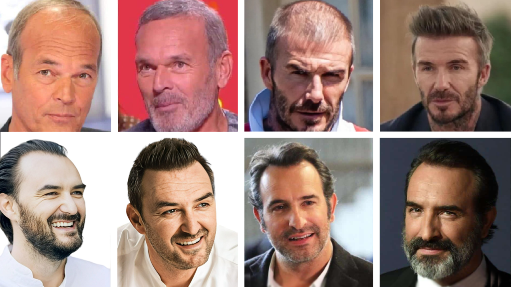 Greffe de cheveux chez les stars