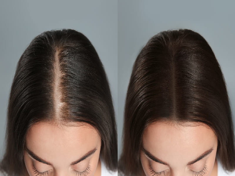 Mésothérapie Cheveux avant après