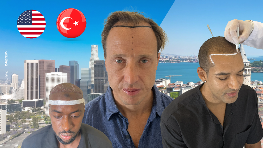 FUE Hair Transplant in Los Angeles