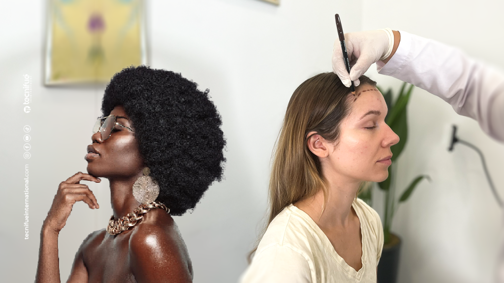 Is a Female Hair Transplant Permanent