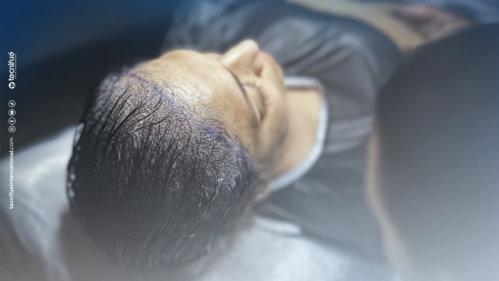 DHI Female Hair Transplant