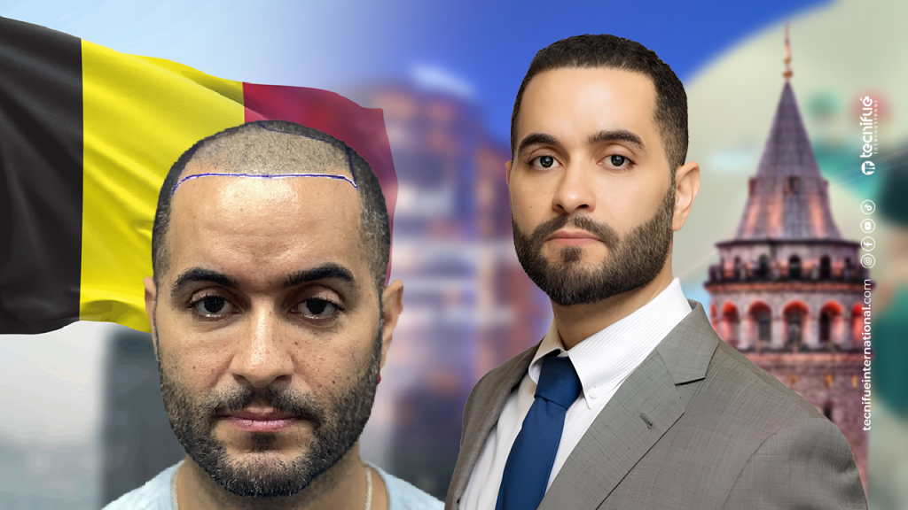 Greffe de cheveux before after