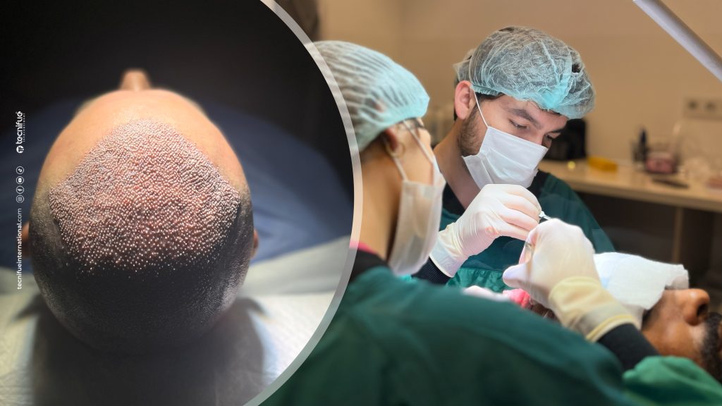 Hair Transplant Grafts