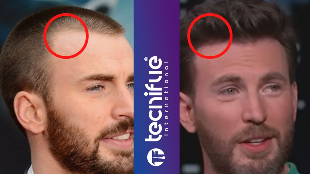 Chris Evans Hair before after