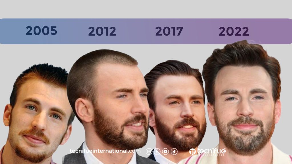 Chris Evans Hair Transplant Rumors
