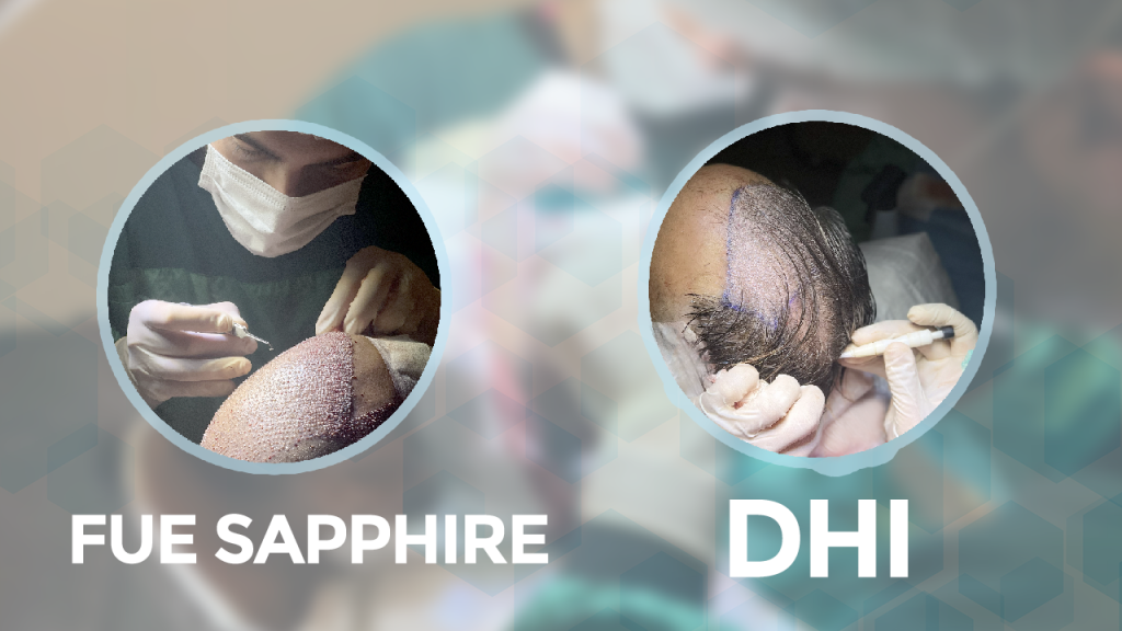 Forfait Greffe de Cheveux Turquie FUE VS DHI