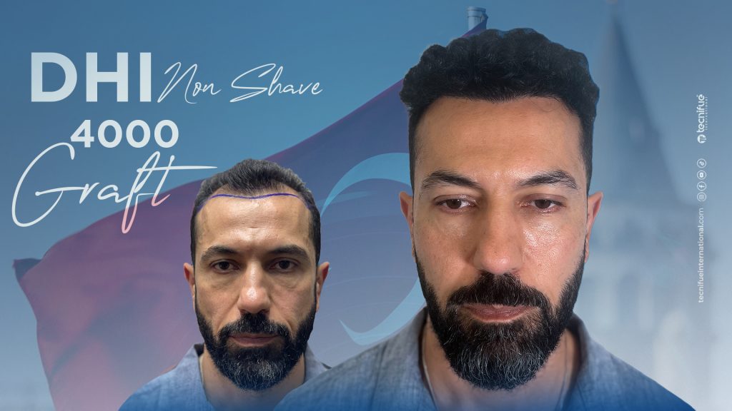 hair transplant cost in USA before after