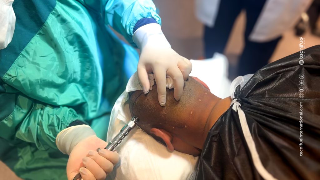 Anesthésie sans aiguille et greffe de cheveux 