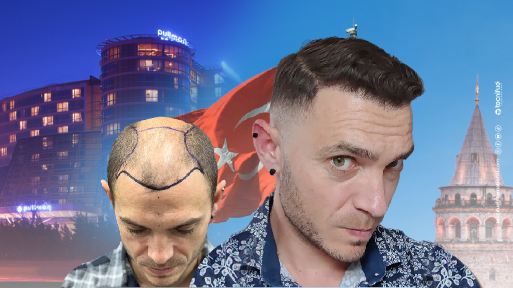 Forfait Greffe de Cheveux Turquie Avant Après 