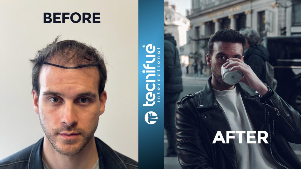 Hair Transplant Surgery Before After