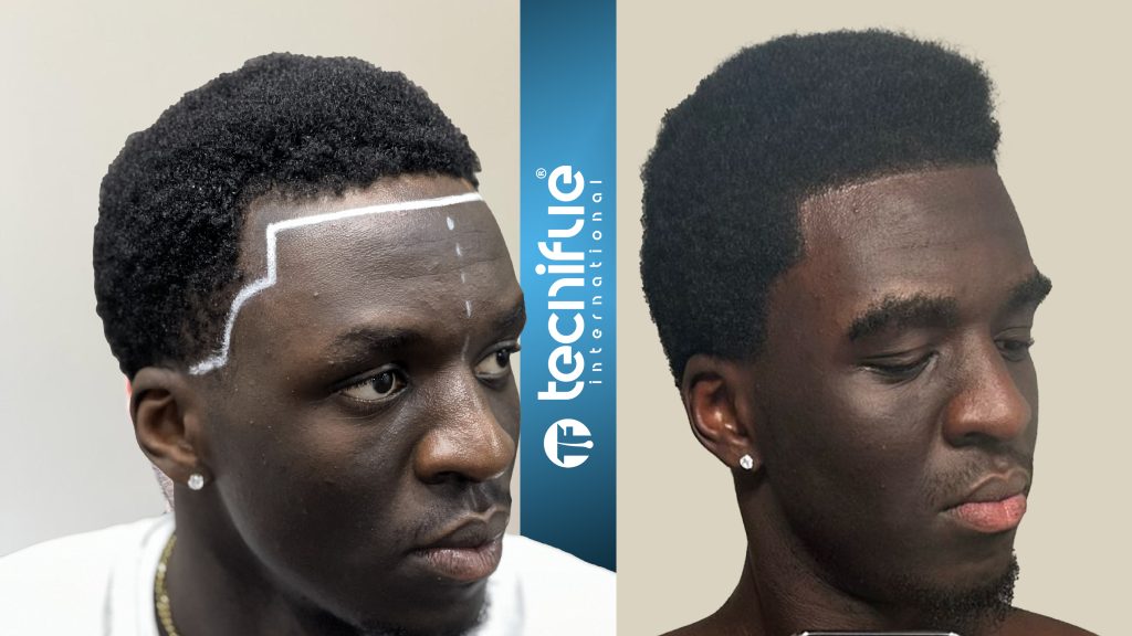 Hair Transplant Afro Before After